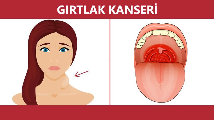 Gırtlak kanseri